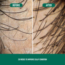 CH004 Minoxidil Anti-Hair Loss Mousse – Hair Growth Treatment for Men & Women
